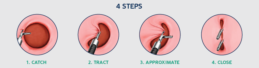 4 steps